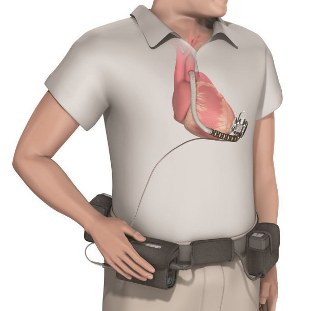 Picture 2 of Thousands of people with heart disease can be saved by this invention