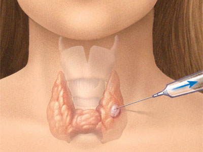 Picture 2 of Thyroid cancer: How to detect and treat