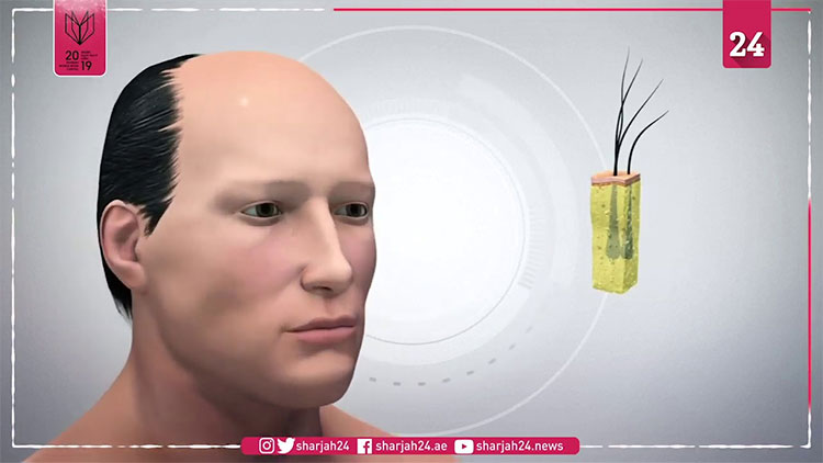 Picture 4 of Treatment of baldness with 3D printing technology