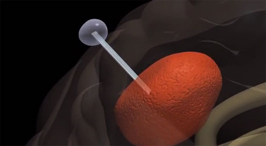 Picture 1 of Treatment of brain tumors using technology