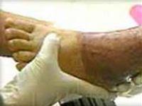 Picture 1 of Treatment of burns with fibroblast transplantation