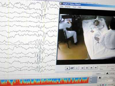 Picture 1 of Treatment of epilepsy by surgery