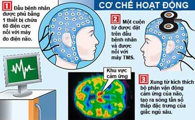 Picture 2 of Treatment of insomnia: Do not use drugs, use waves to impact the brain