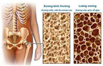 Picture 2 of Treatment of osteoporosis with infusion