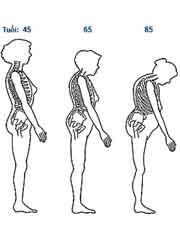 Picture 3 of Treatment of osteoporosis with infusion