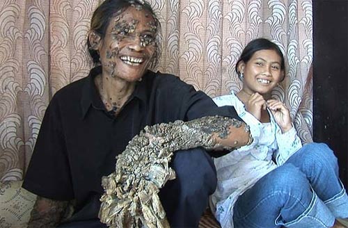 Picture 1 of 'Tree people' in Indonesia