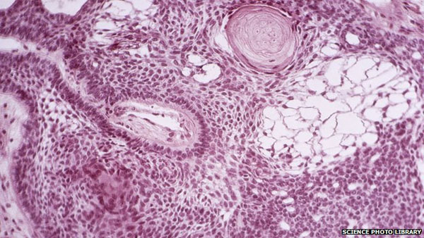 Picture 1 of Turn stem cells into cancer machines