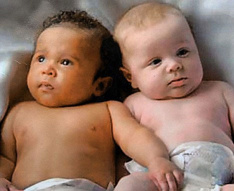 Picture 2 of Twins are different in skin color