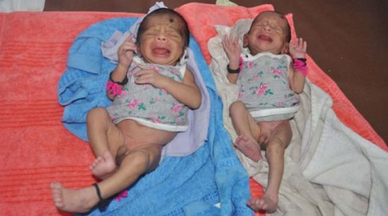 Picture 1 of Two twins from two wombs are different