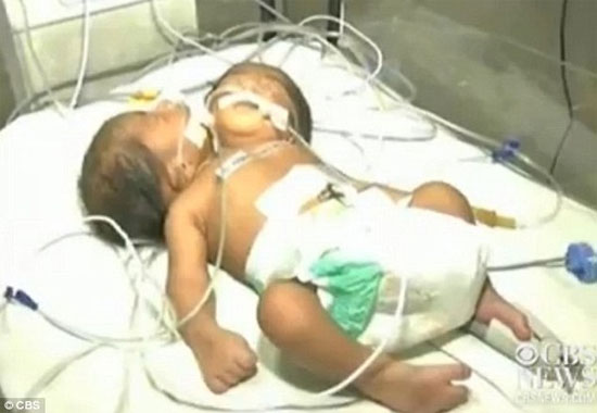 Picture 1 of Two-headed boys are born in India