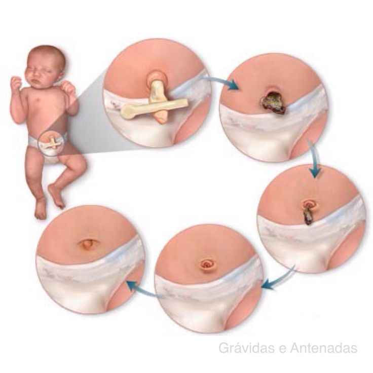 Picture 2 of Umbilical care for babies