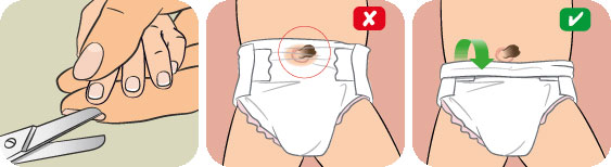 Picture 3 of Umbilical care for babies