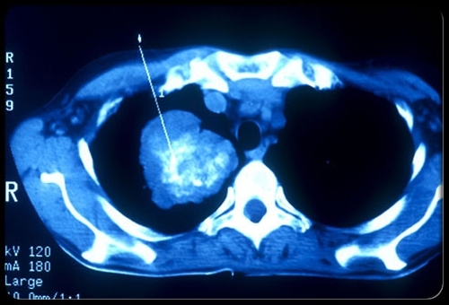 Picture 3 of Understanding pleurisy cancer Meritorious patient Han Van Tinh