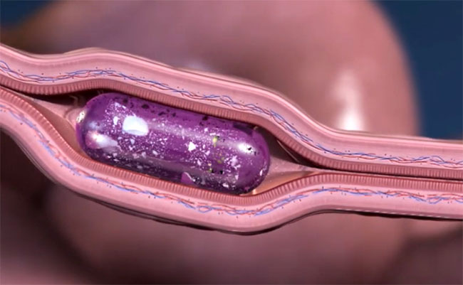 Picture 1 of Unique injection technology does not hurt by stabbing needles straight into the intestinal wall