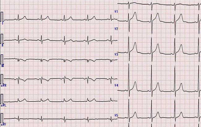 Picture 2 of Unknown things about ECG