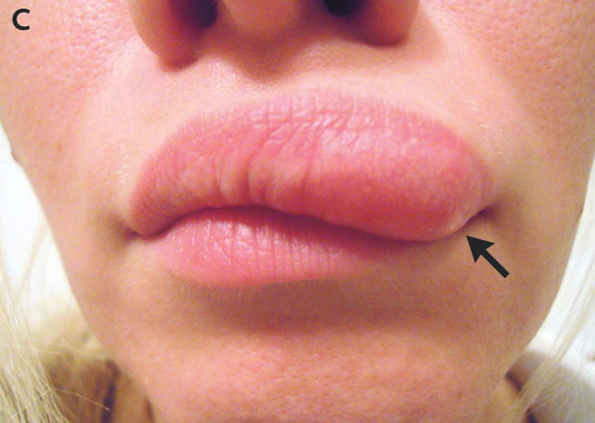Picture 4 of Use a selfie to keep track of 'parasitic worms' moving back and forth on the face for 2 weeks