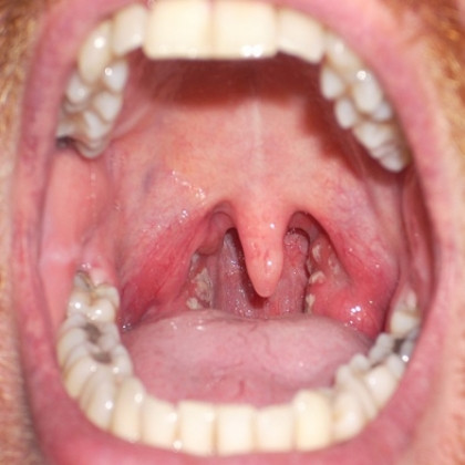 Picture 1 of Use of penicillin to treat strep throat: What should be noted?
