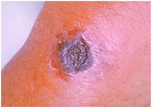 Picture 2 of Vaccines against anthrax