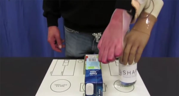 Picture 1 of Video: Austrian patient uses the thought of controlling the prosthetic hand