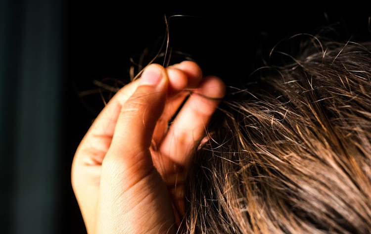 Picture 1 of Video: Syndrome causes many addicts to pluck their hair and hair