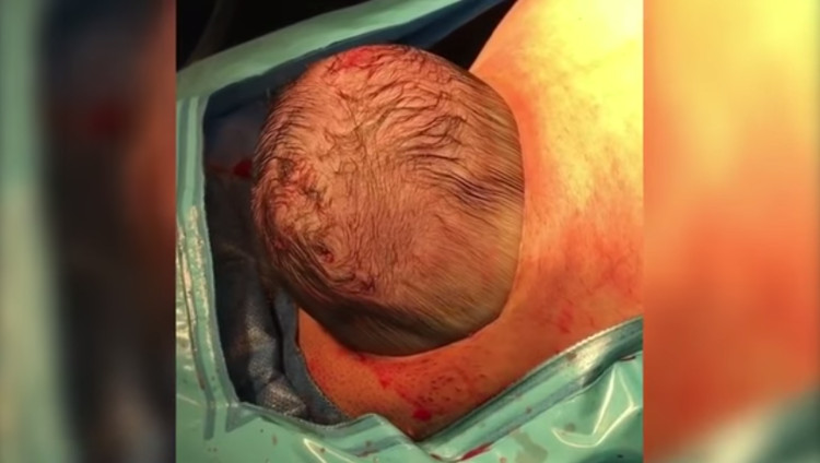 Picture 1 of Video: The baby comes out of the womb