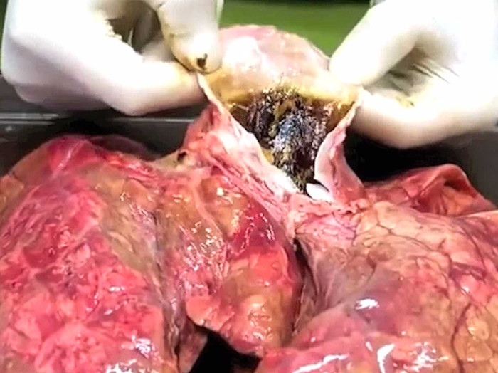Picture 1 of Video: The lungs are dark after smoking 20 cigarettes