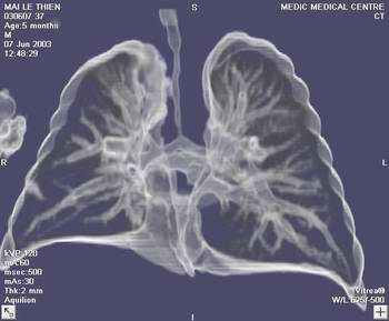 Vietnam can produce breathing machines at low cost images 1