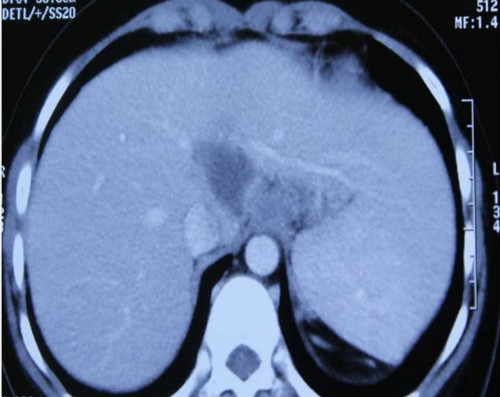 Vietnamese girl became the second rarest case of tuberculosis in the world images 1
