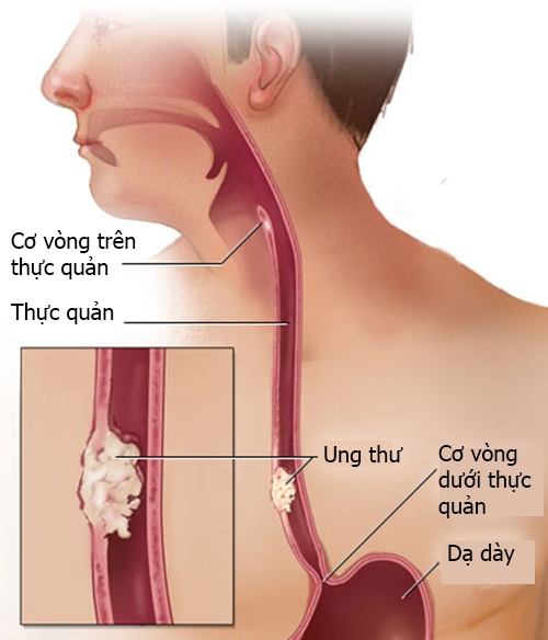Picture 1 of Visible signs of esophageal cancer
