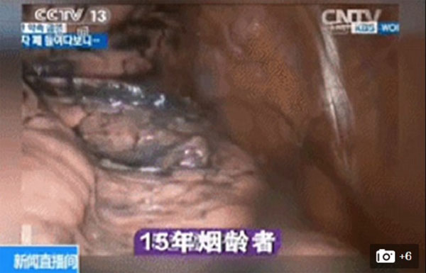 Picture 3 of Visual video of smokers' black lungs
