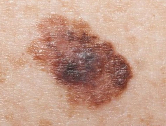 Picture 1 of Warning of antioxidants accelerates cancer metastasis