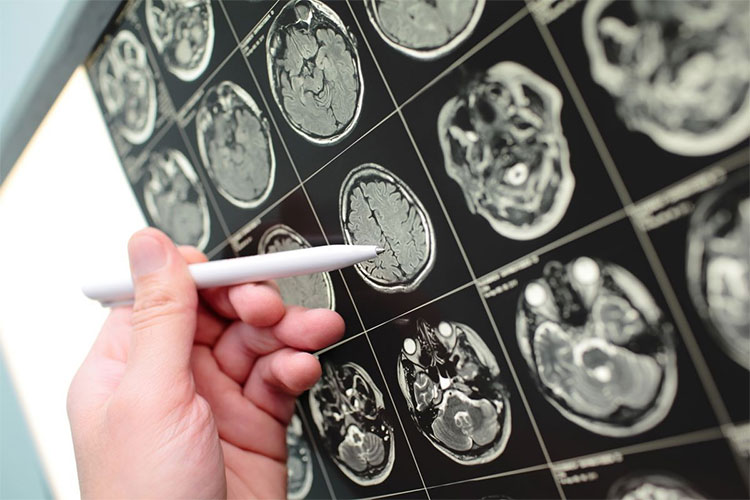 Picture 1 of Warning signs for brain tumors