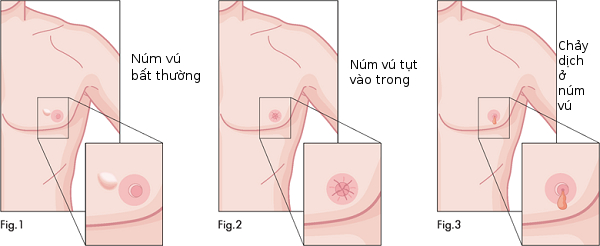 Picture 1 of Warning signs of breast cancer in men