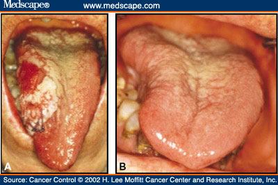 Picture 2 of Warning signs of tongue cancer