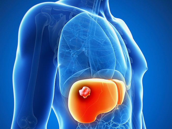 Picture 2 of Watch out for signs of liver cancer