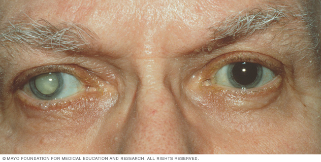Picture 3 of Wear sunglasses even in the 'cold winter' days, if you don't want to pay the price