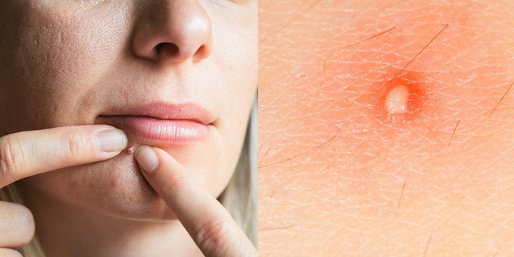 Picture 1 of What created acne?