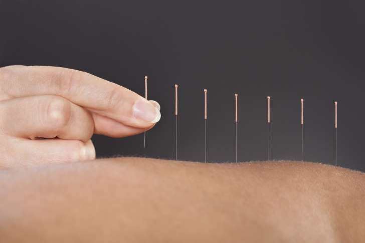 Picture 1 of What is acupuncture?