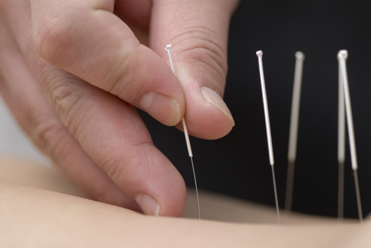 Picture 2 of What is acupuncture?