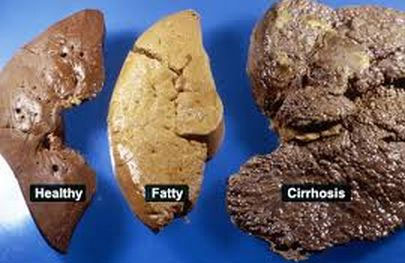 Picture 1 of What is cirrhosis?  Who is most likely to develop cirrhosis?