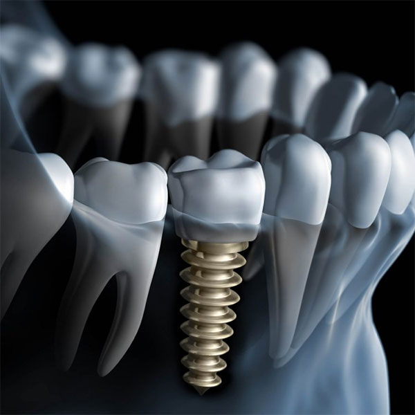 Picture 2 of What is dental implant?
