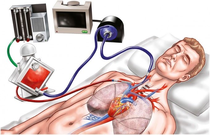 Picture 1 of What is ECMO?  When does the patient need ECMO intervention?
