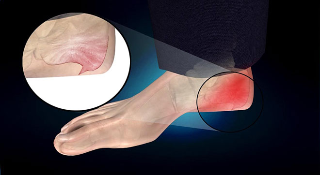 Picture 1 of What is heel bone spines?