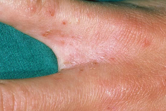 Picture 2 of What is scabies?