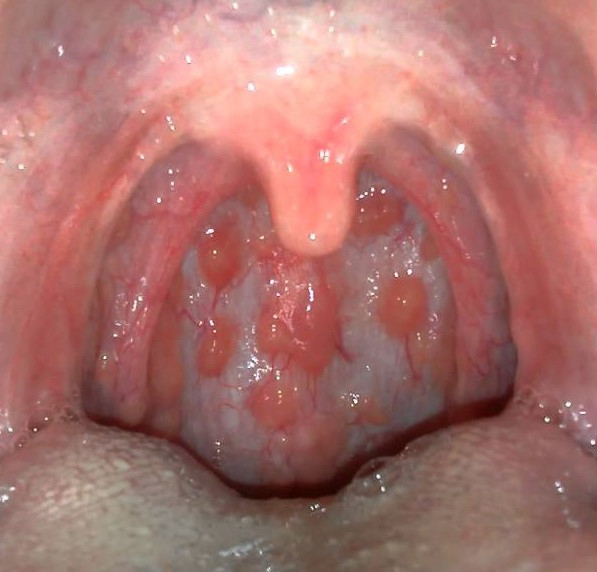 Picture 1 of What is sore throat disease?