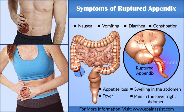 Picture 2 of What is the effect of appendicitis?