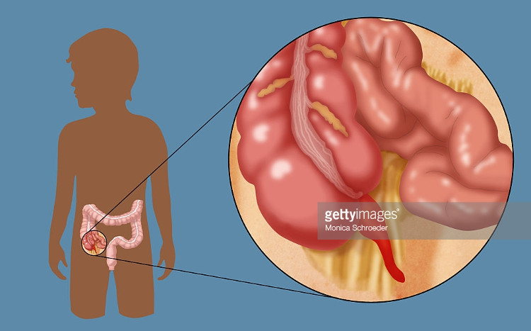 Picture 3 of What is the effect of appendicitis?