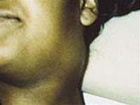 Picture 1 of What is the swollen lymph gland?