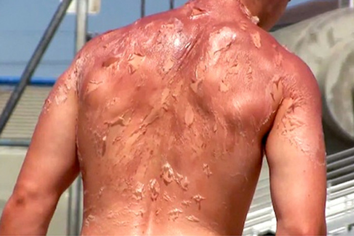 Picture 3 of What really happened when we were sunburned?
