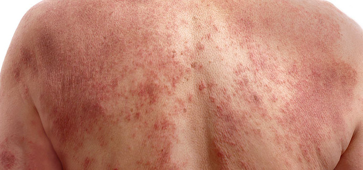 Picture 4 of What really happened when we were sunburned?